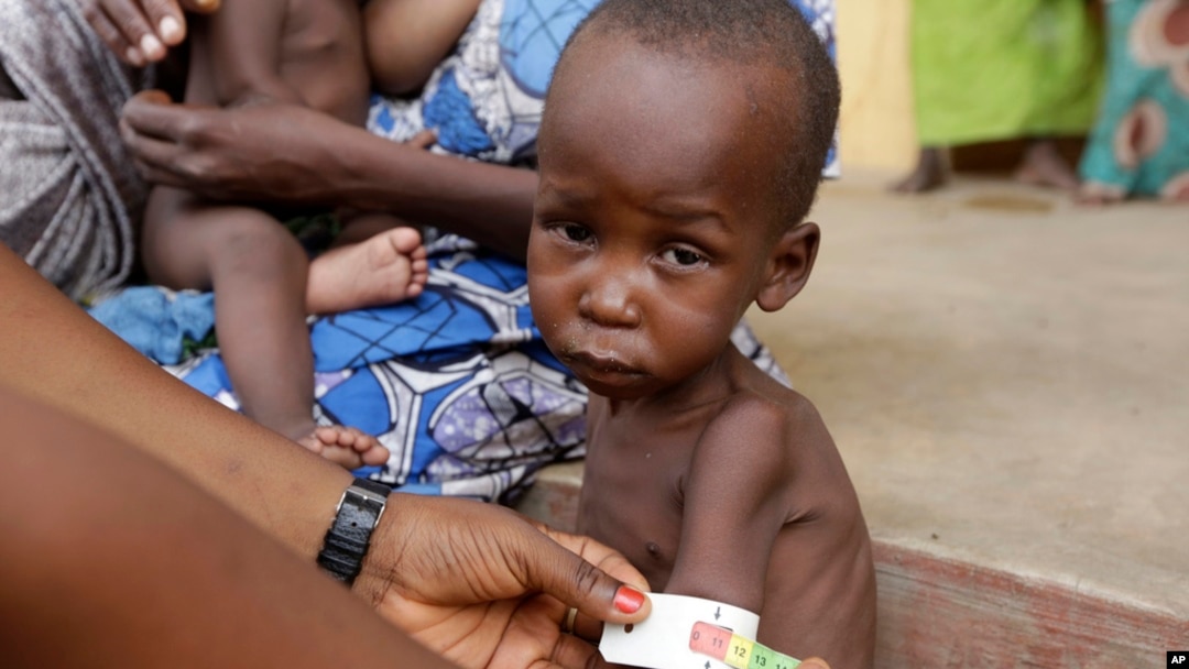 FILE- A doctor attends to a malnourished child at a refugee camp in Yola, Nigeria. May 3, 2015.