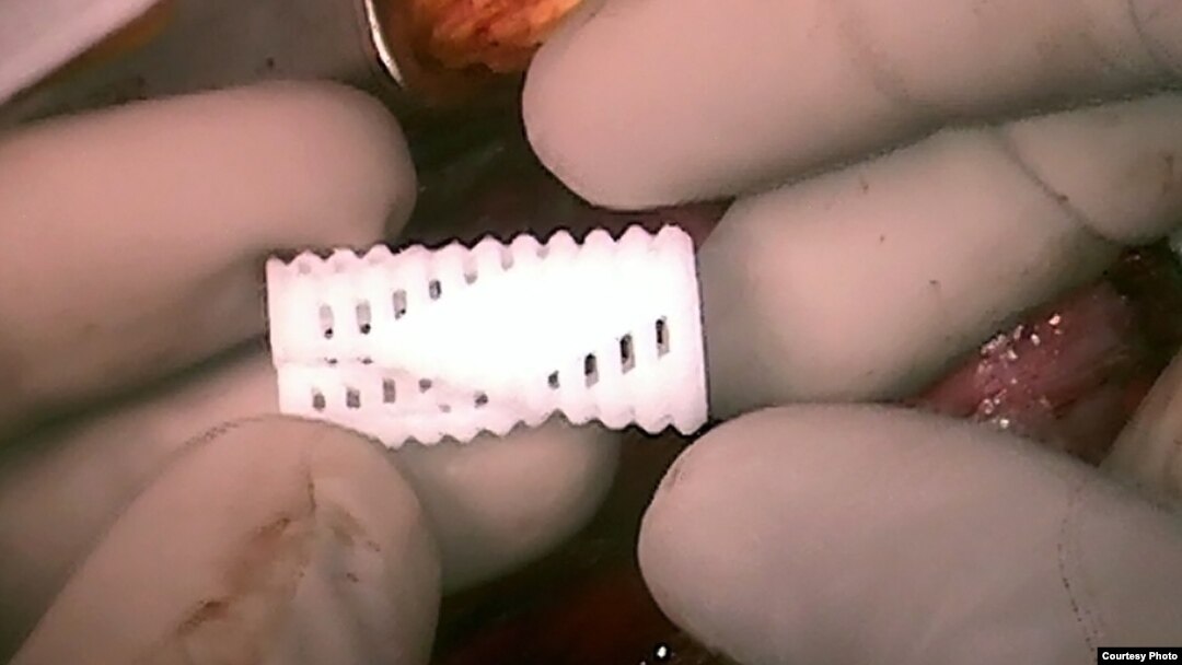 Final 3D-printed tracheobronchial splint used to treat the left bronchus of patient 2. (Morrison et al., Science Translational Medicine, 2015)