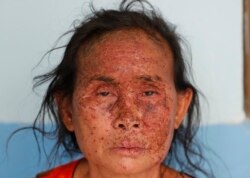 An ethnic Karen villager from Myanmar rests after crossing the Salawin river via boat at Ban Mae Sam Laep Health Center, Mae Hong Son province, Thailand, on March 30, 2021.
