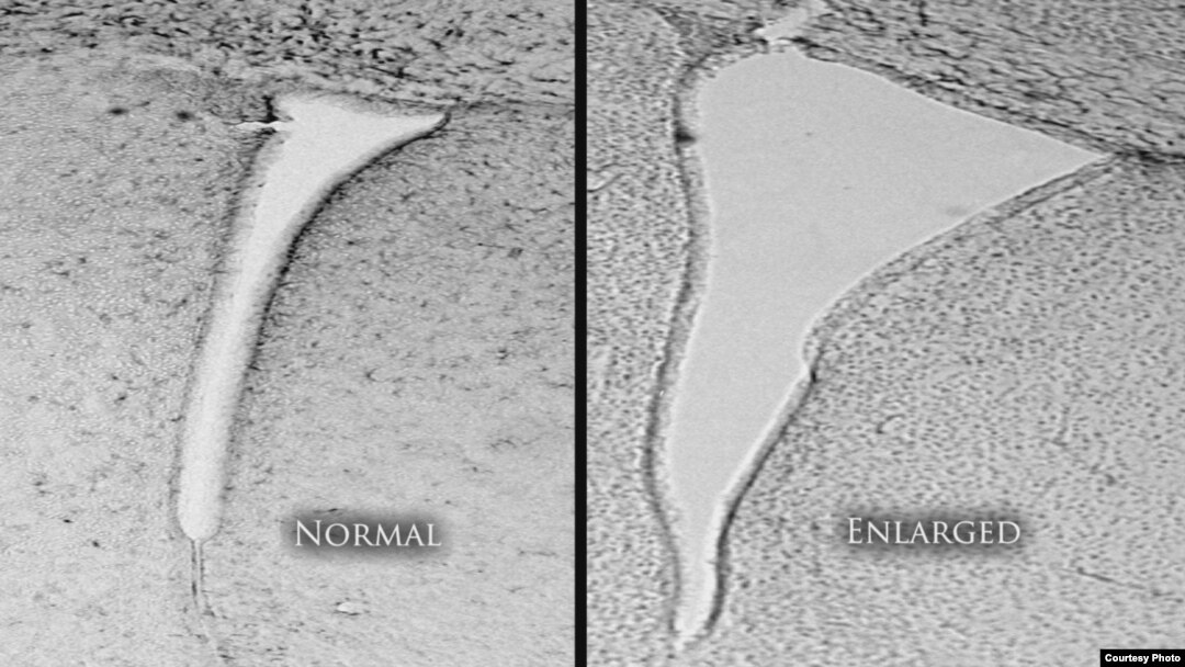 A mouse brain that was exposed to polluted air shows an enlarged lateral ventricle (right) compared with a mouse whose air was clean and filtered. Enlarged lateral ventricles are associated in humans with autism and schizophrenia. (University of Rochester Medical Center)