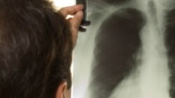 Tuberculose em Malanje 1:41