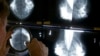 FILE - Radiologist uses magnifying glass to check mammograms for breast cancer in Los Angeles.