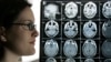 FILE - Kyla Nagel stands next to her brain scan at her home in Springfield, Ore. Nagel was diagnosed with an aggressive brain cancer.