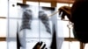 FILE - A doctor examines chest X-rays at a tuberculosis clinic in Cape Town, South Africa. 