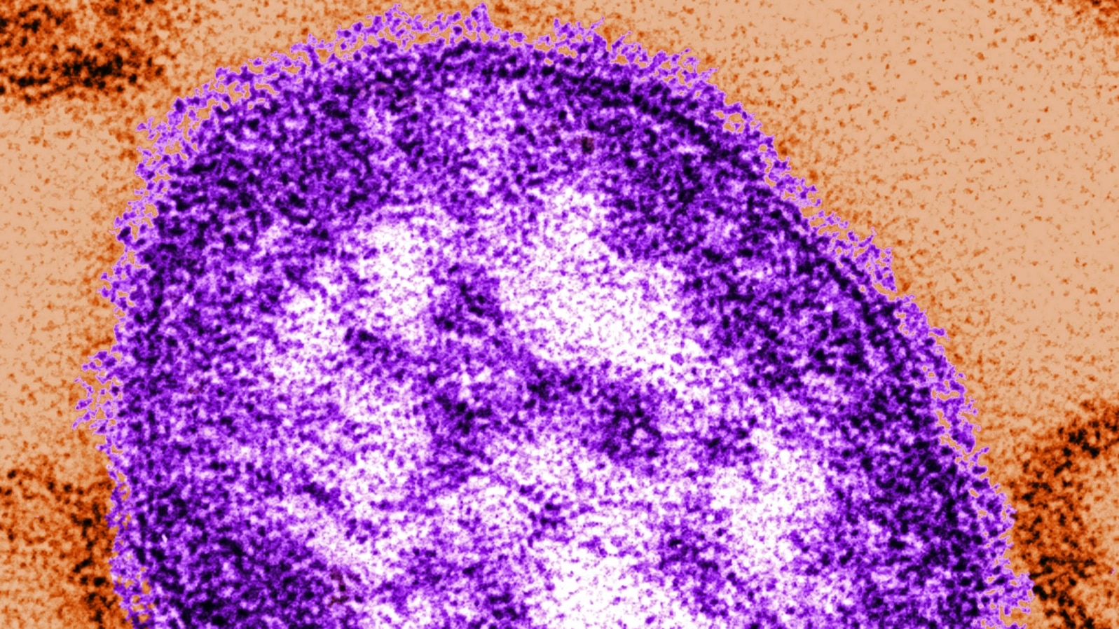 FILE - An undated electron microscope image of a measles virus particle.